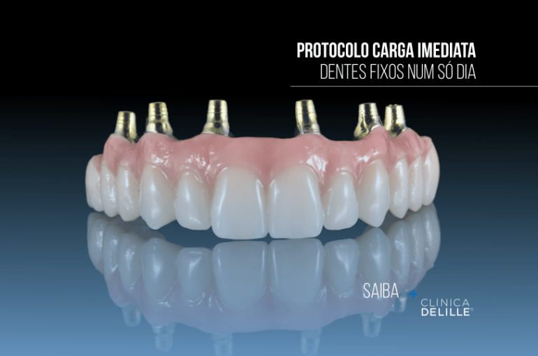Protocolo Carga Imediata: Dentes Fixos num só dia