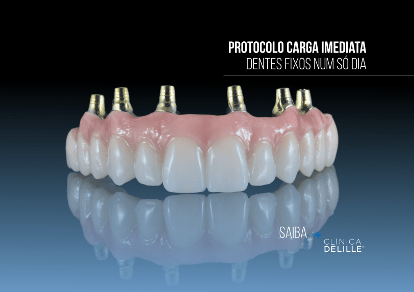 Protocolo Carga Imediata: Dentes Fixos num só dia