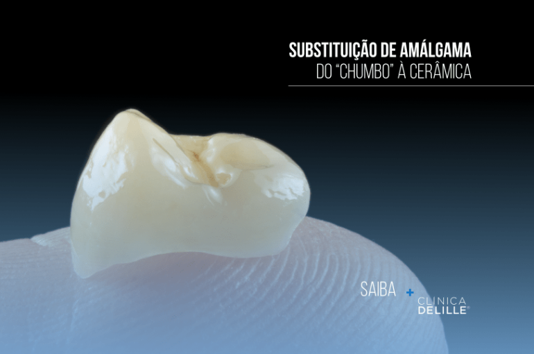 Dentisteria Estética: Substituição de amálgama