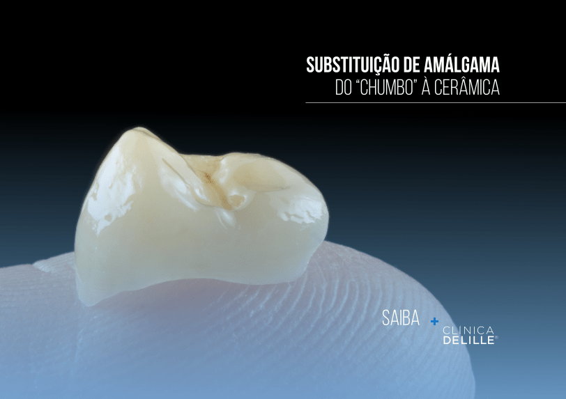 Dentisteria Estética: Substituição de amálgama