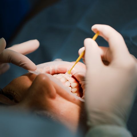 Facetas Dentárias