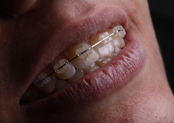 As principais dicas para uma boa Higiene Oral com Aparelho Dentário Fixo