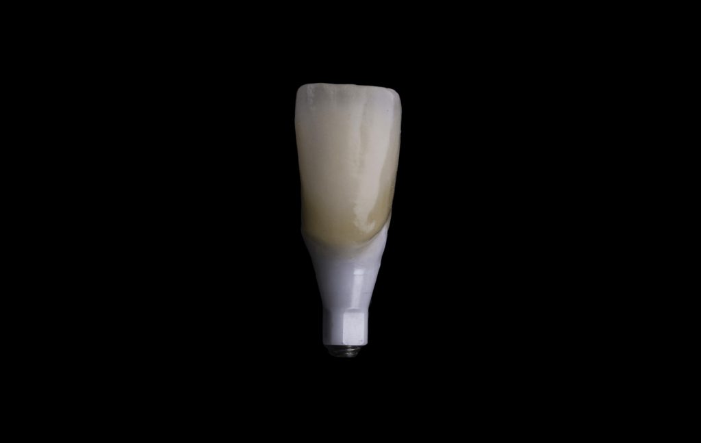 Implante Dentário - Clínica Delille