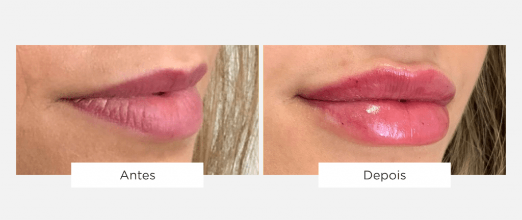 tratamento de estética lábios