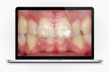 Tem “manchas brancas” nos dentes? Sabia que é possível removê-las?