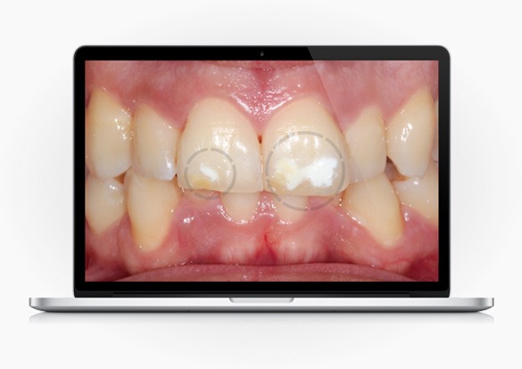 Tem “manchas brancas” nos dentes? Sabia que é possível removê-las?