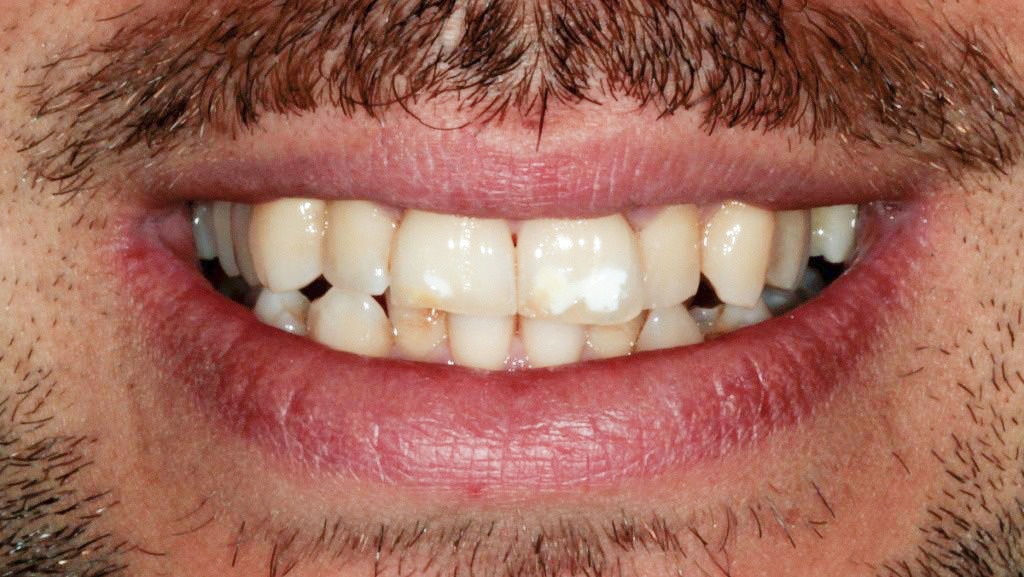 manchas brancas nos dentes