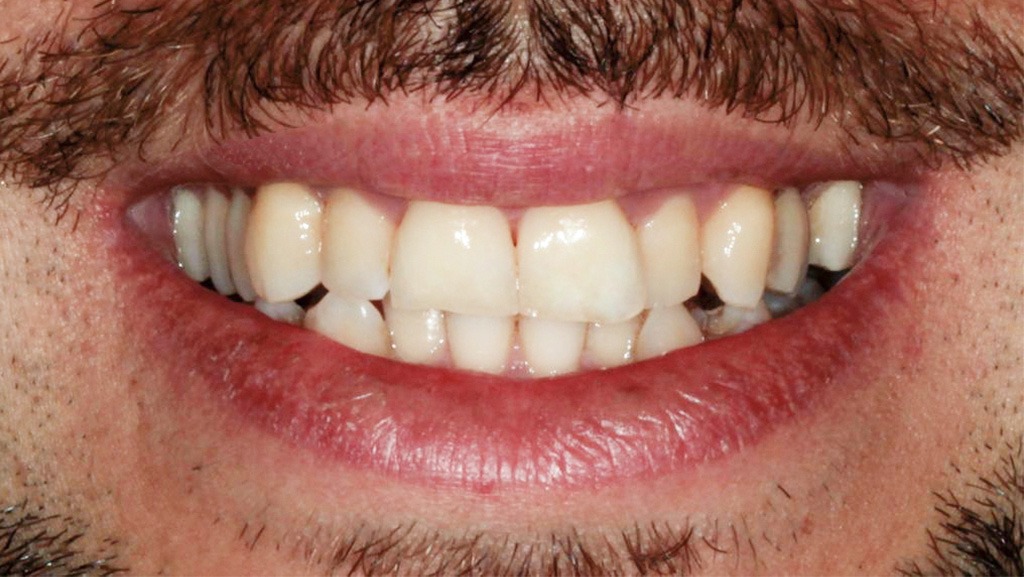 manchas brancas nos dentes