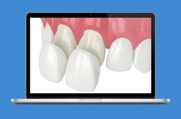 Facetas Dentárias diretas e indiretas – Qual a diferença? De que material são feitas? Como são aplicadas? Quanto custam?
