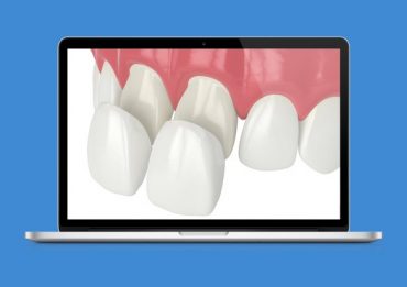 Facetas Dentárias diretas e indiretas – Qual a diferença? De que material são feitas? Como são aplicadas? Quanto custam?