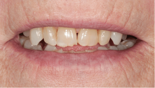 facetas dentárias