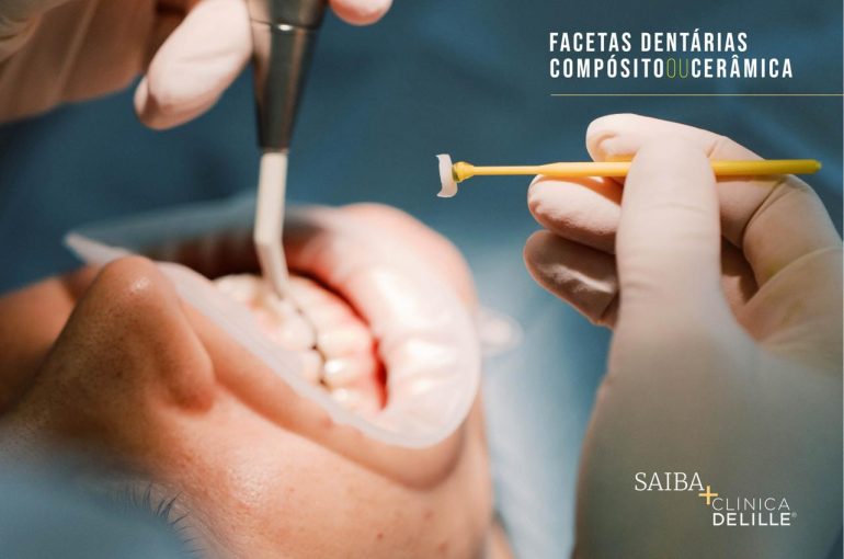Facetas Dentárias: Tudo o que precisa de saber