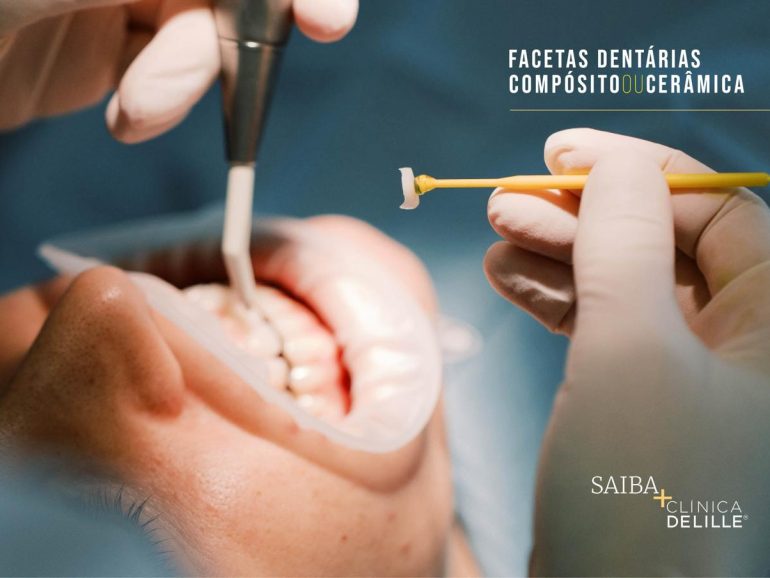 Facetas Dentárias: Tudo o que precisa de saber