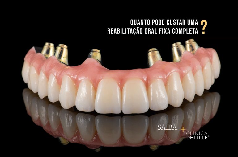 Quanto pode custar uma reabilitação oral fixa completa?