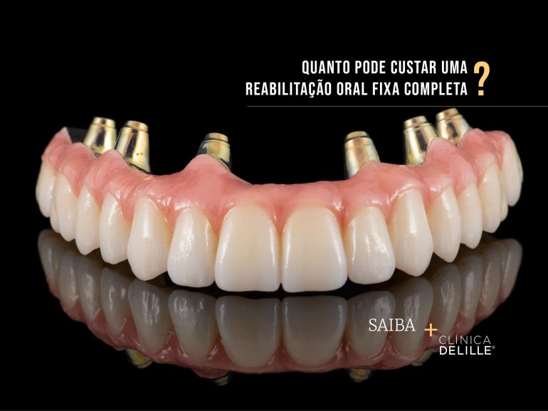 Quanto pode custar uma reabilitação oral fixa completa?