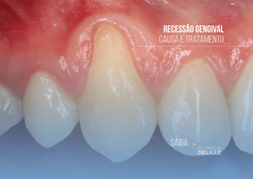 Recessão gengival: Por que acontece e como pode ser tratada?