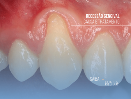 Recessão gengival: Por que acontece e como pode ser tratada?