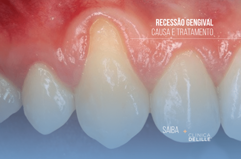 Recessão gengival: Por que acontece e como pode ser tratada?