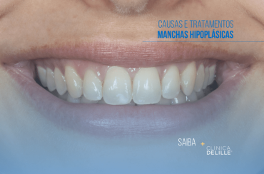 Dentisteria Estética: Manchas Hipoplásicas – Causas e Tratamentos