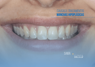 Dentisteria Estética: Manchas Hipoplásicas – Causas e Tratamentos