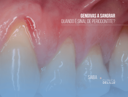 Gengivas a sangrar: Quando é sinal de doença periodontal?