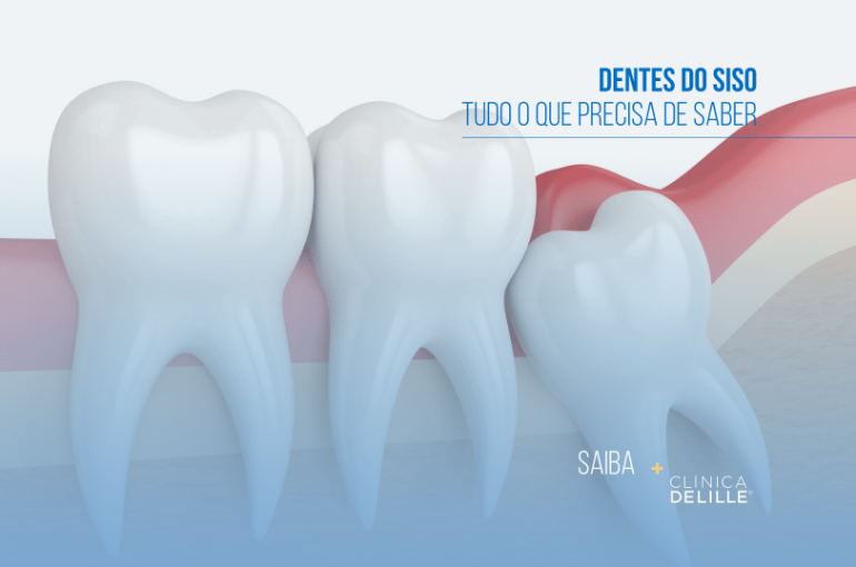Dentes do Siso: Tudo o que precisa de saber