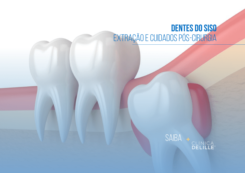 Dentes do Siso: Extração e Cuidados Pós-Cirurgia